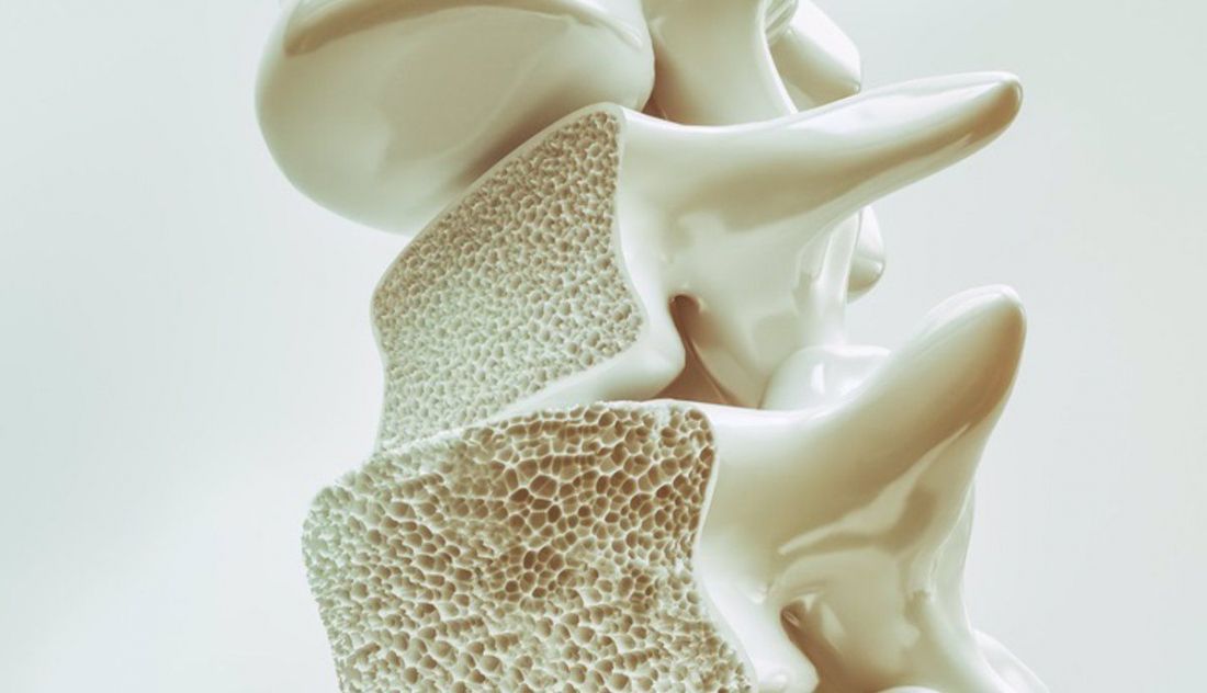 Osteoporosis. Foto Infosalus