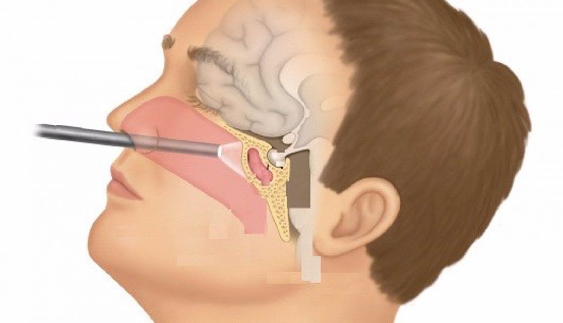 Tumor hipofisario. Foto de Infosalus