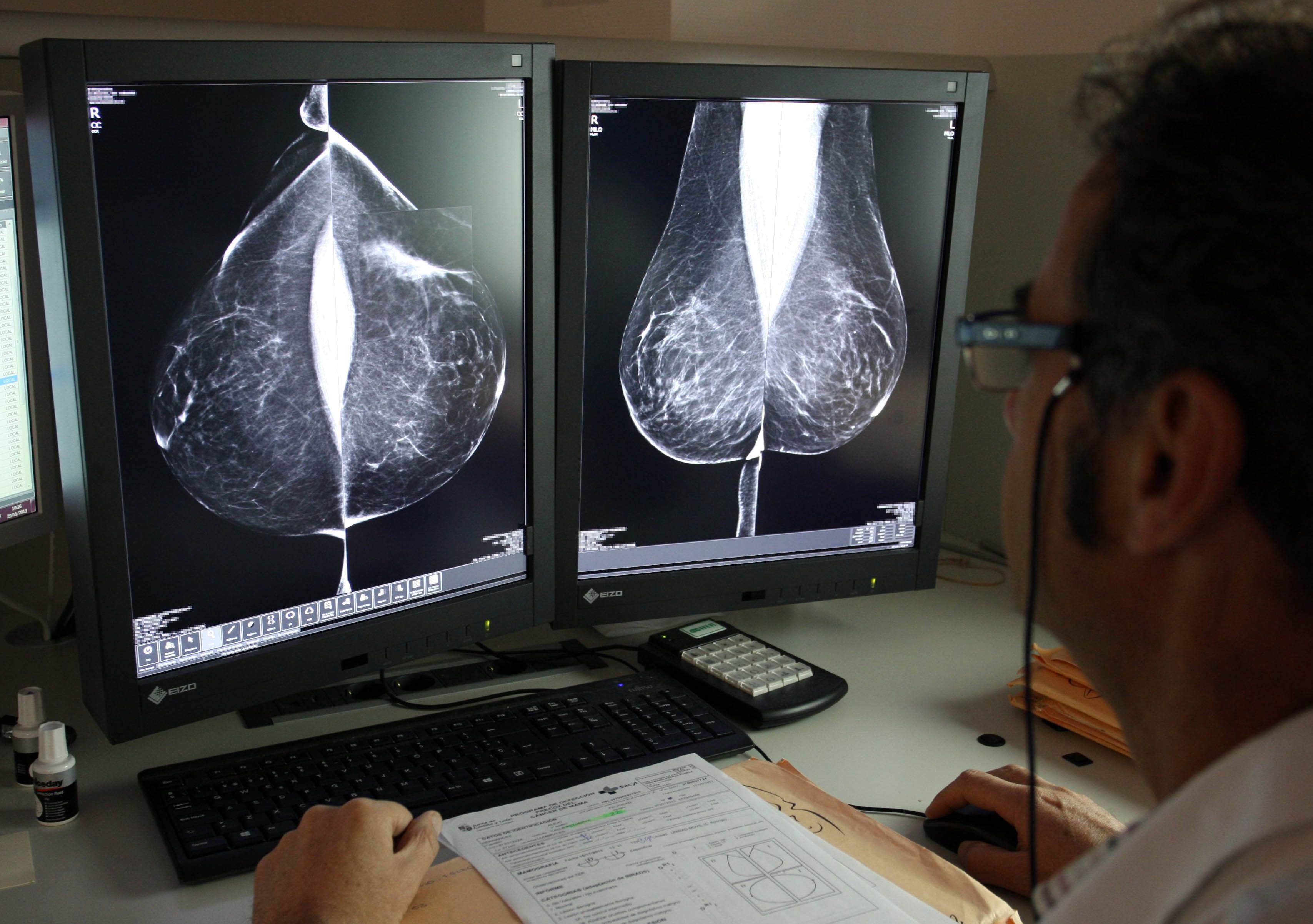 Rubén Cacho. Estudio de una mamografía digital en el servicio de mamografías del Hospital Río Hortega de Valladolid